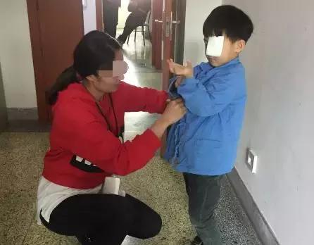 斜眼白內障