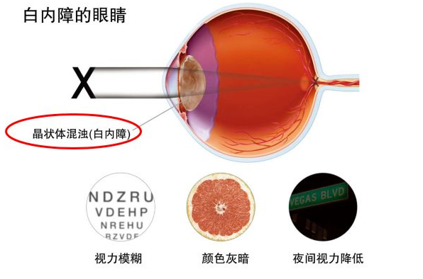 白內障癥狀