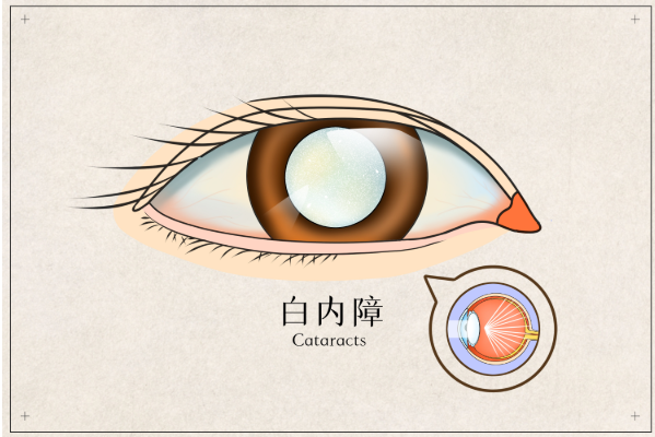 白內障癥狀